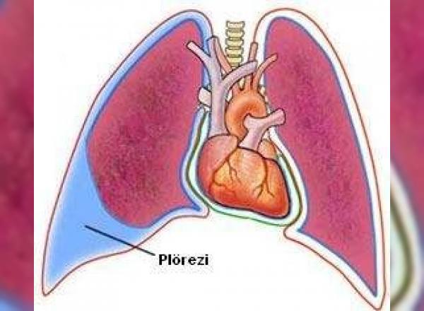 Plörezi nedir? Plörezi belirtileri nelerdir?