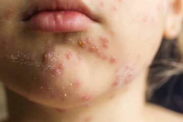 Kızamık ölümleri bir yılda yüzde 40 arttı